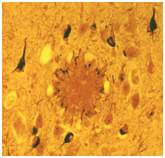 Amyloid Plaque