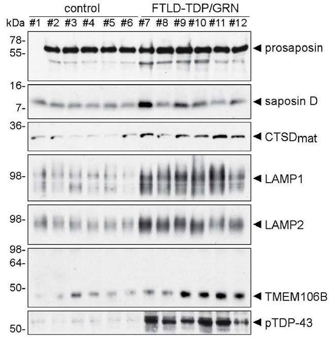 Common pathobiochemical hallmarks of progranulin-associated frontotemporal lobar degeneration and neuronal ceroid lipofuscinosis.