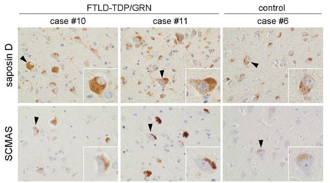 Common pathobiochemical hallmarks of progranulin-associated frontotemporal lobar degeneration and neuronal ceroid lipofuscinosis.
